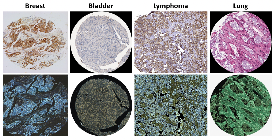 Histopathological Classification Of Cancer Via Deep Learning Dias