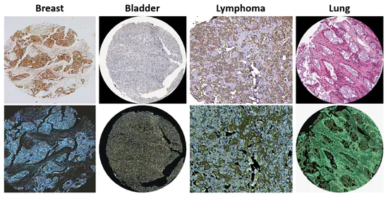 Histopathological classification of cancer via Deep Learning